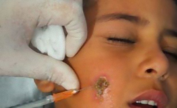 اللشمانيا-31-300x183_e